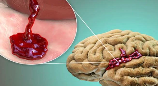¿Cuáles son los síntomas de la hemorragia cerebral?