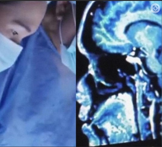 Vivo y retorciéndose, médicos extraen "gigante" gusano del cerebro de una mujer