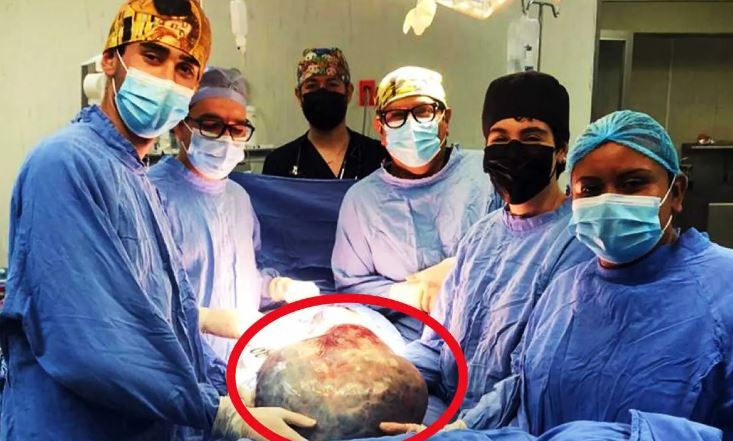 Quitan gigante tumor de 21 kilos a paciente del IMSS