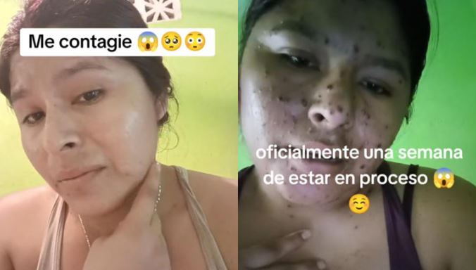 (VÍDEO) Mujer asegura que se contagió de viruela, pero era varicela