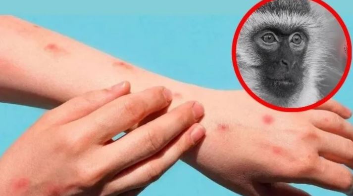 ¡Alerta en México! Brote de mpox; confirman primeros casos