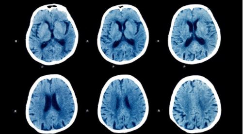 COVID-19 puede dañar el cerebro; científicos luchan por entender por qué