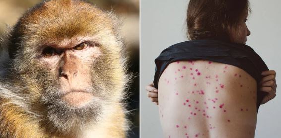 Formas de contagio de la viruela del mono en México
