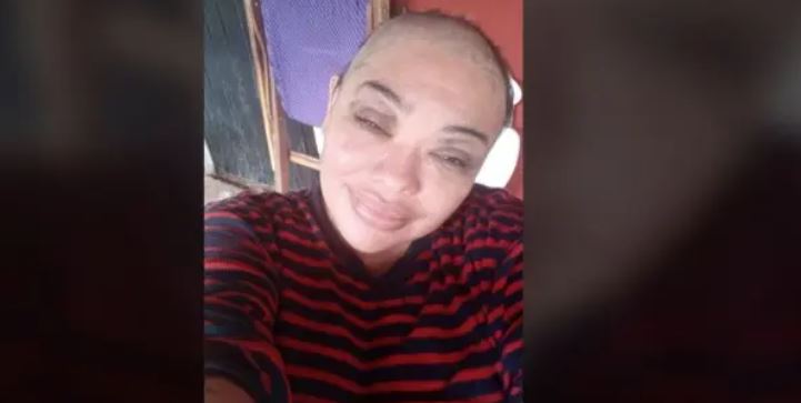 Mérida: Joven mujer con cáncer relata el viacrucis que vive y pide ayuda