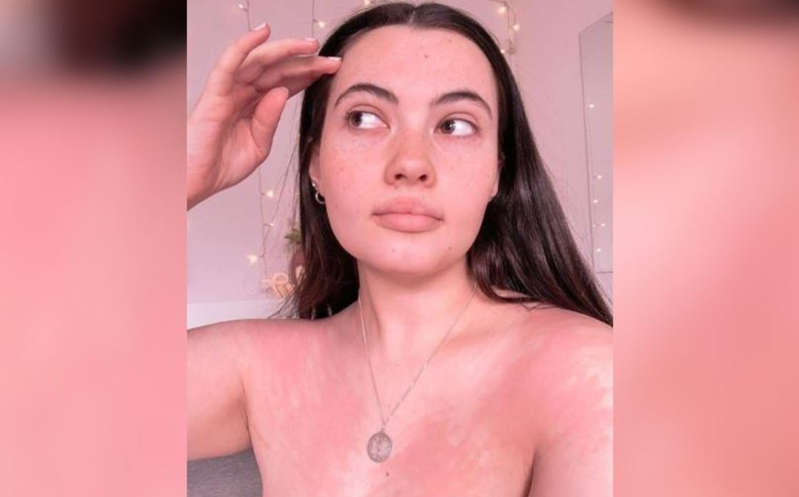 Joven sufre de erupciones en la piel al ser alérgica al agua y al sudor