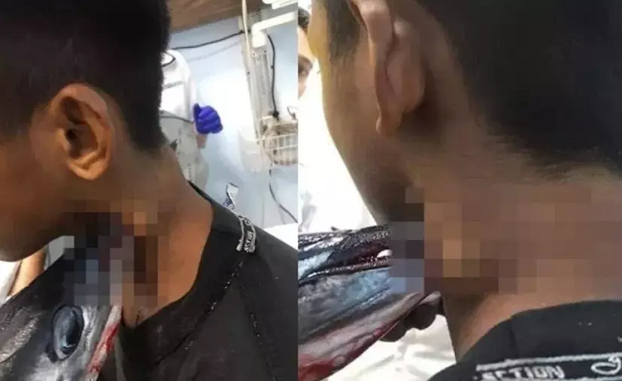 Operan a joven para sacarle un pez espada del cuello