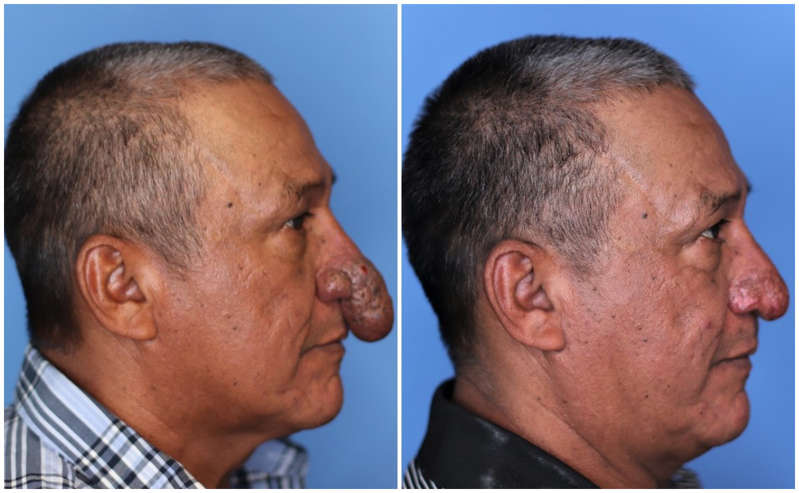 Cirujano plástico regala reconstrucción de nariz a obrero que trabajaba en su casa