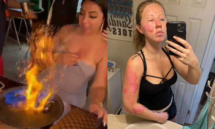 (VIDEO) Meseros de Cancún queman, por accidente, el rostro a una turista