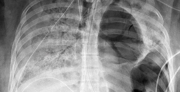 Covid destruyó pulmones a una joven y tuvieron que trasplantarle otros